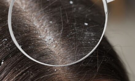 Natural Ways to Reduce Dry Scalp