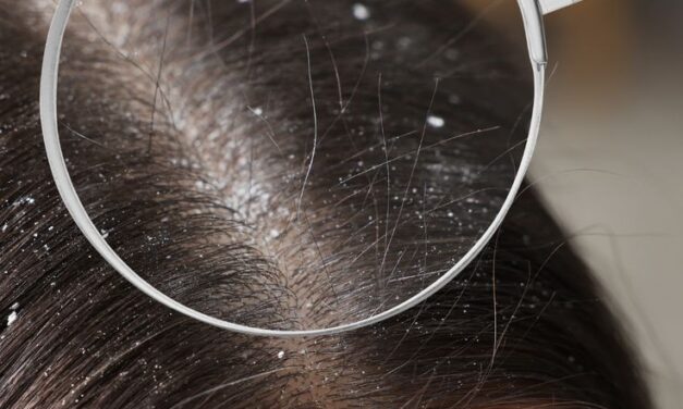 Natural Ways to Reduce Dry Scalp