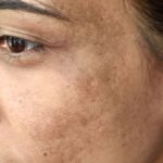 How to Reduce Pigmentation Naturally: Effective Tips for a Clearer, More Even Skin Tone