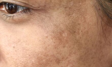 How to Reduce Pigmentation Naturally: Effective Tips for a Clearer, More Even Skin Tone