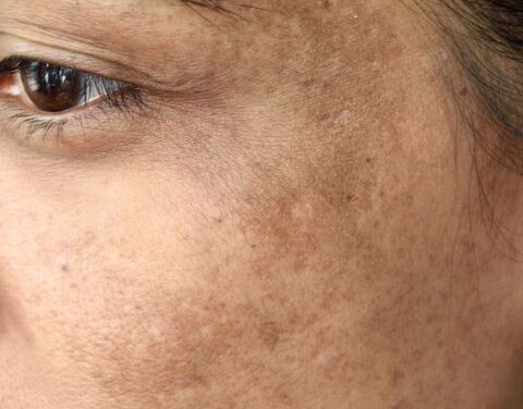 How to Reduce Pigmentation Naturally: Effective Tips for a Clearer, More Even Skin Tone