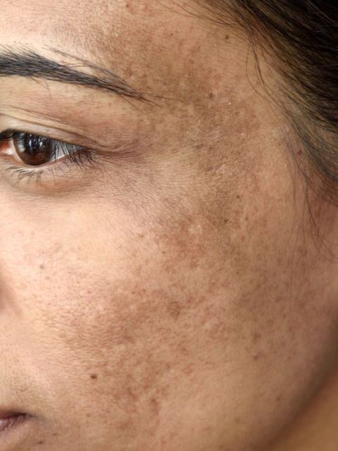 How to Reduce Pigmentation Naturally: Effective Tips for a Clearer, More Even Skin Tone